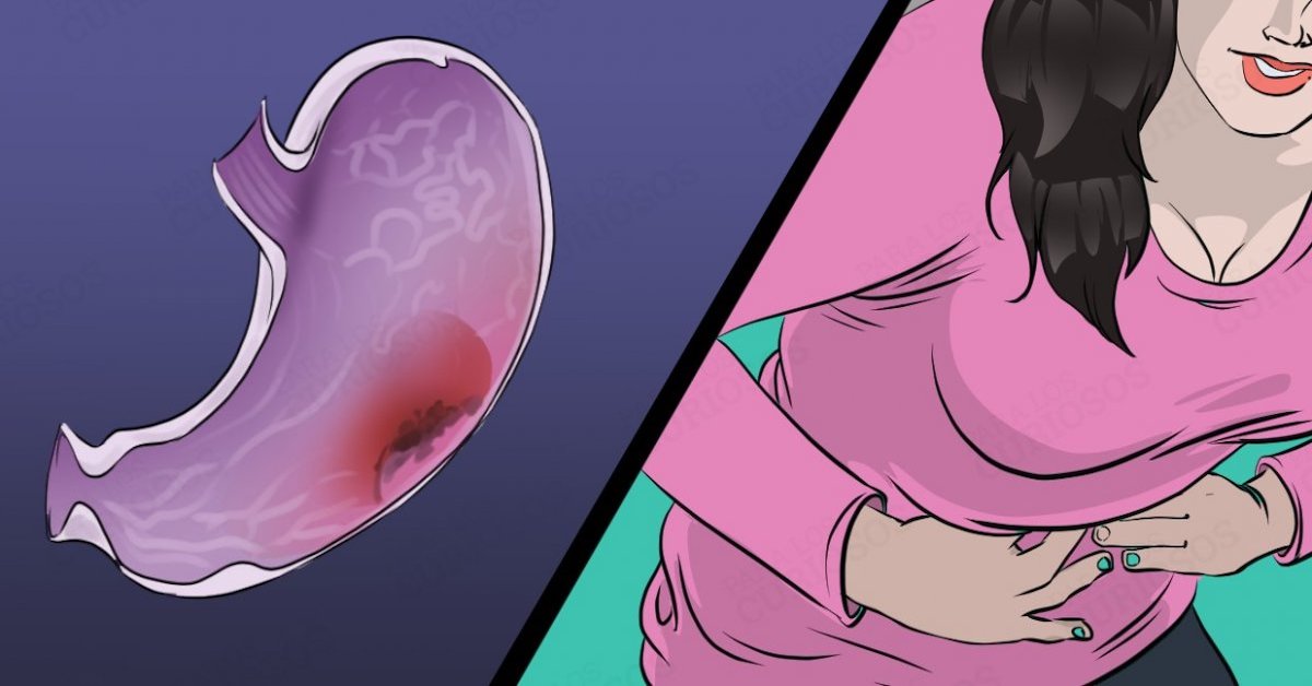 Cancro allo stomaco: cause, sintomi e prevenzione