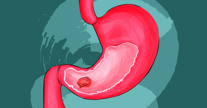 Cancro allo stomaco: cause, sintomi e prevenzione