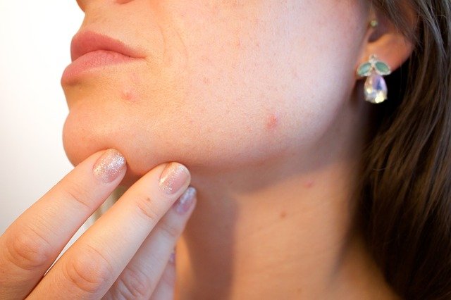 Come eliminare i brufoli dal viso, velocemente