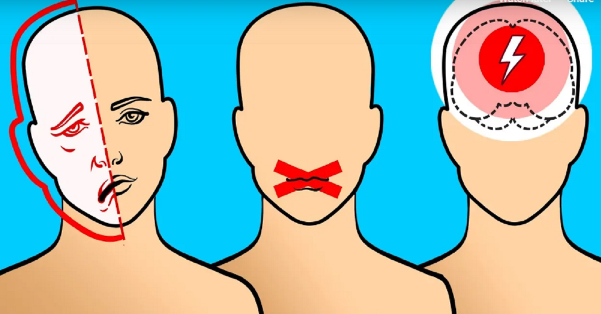 Cinque segnali che ti indicano che stai per soffrire di un ictus