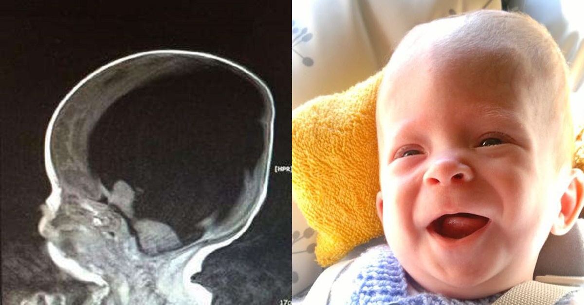 Bambino nato senza cervello sfida ogni probabilità di vita