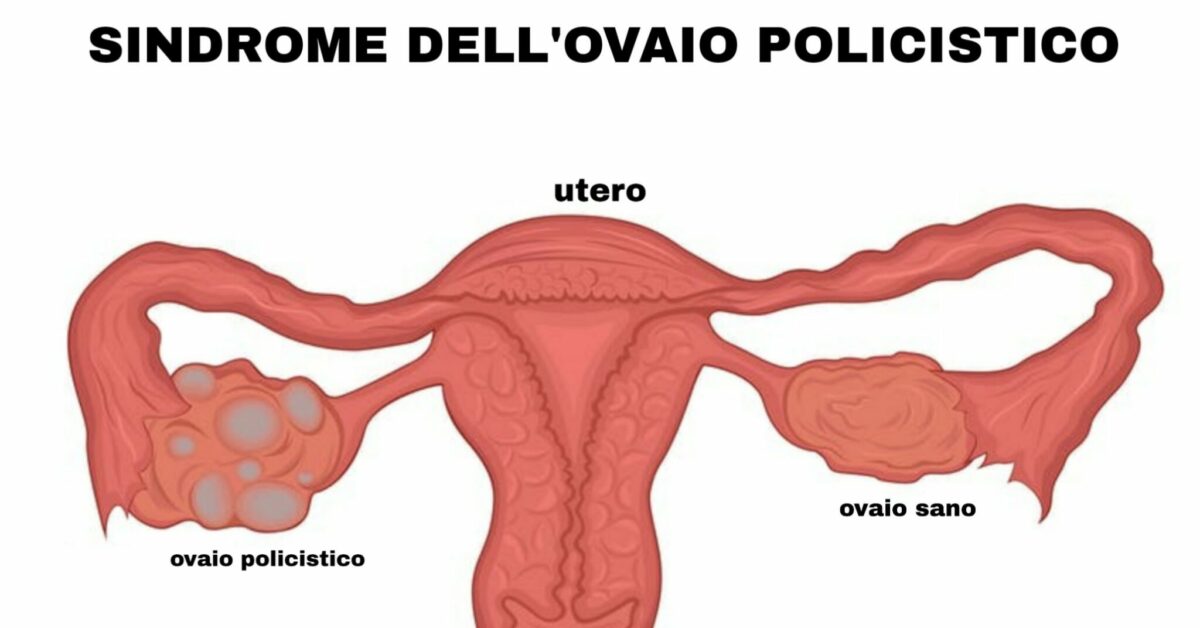 Sindrome dell’ovaio policistico