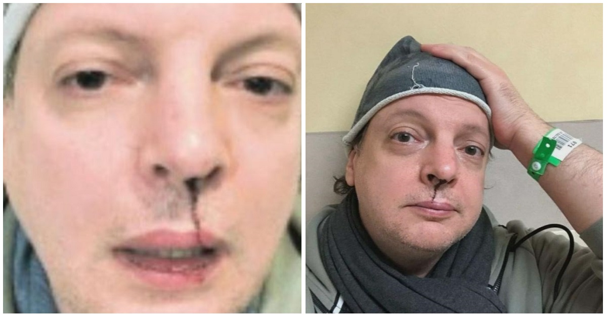 Dado riceve un pugno in faccia dall’ex della figlia