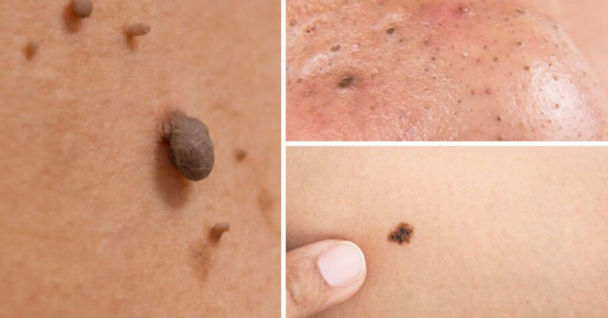 Come curare naturalmente macchie dell'età, verruche e punti neri Bigodino
