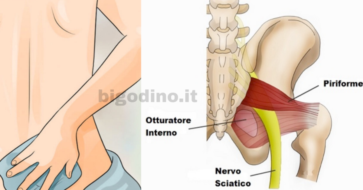 Rimedi naturali per la sciatica