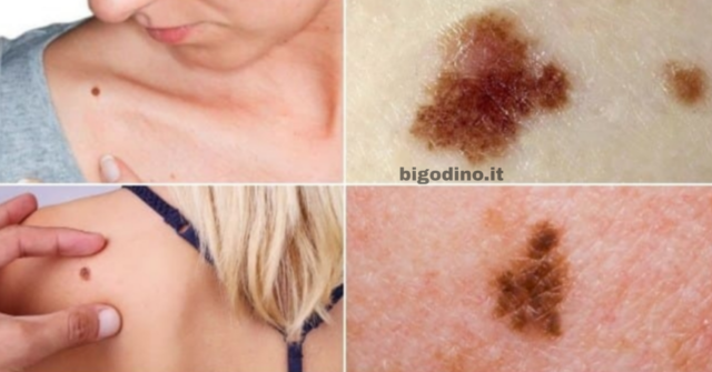 melanoma