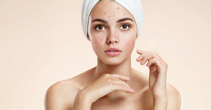 Come curare l’acne in modo naturale