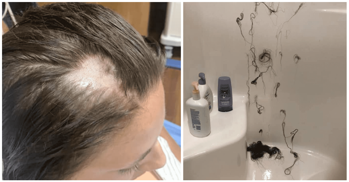 Donna perde capelli dopo aver usato un balsamo mischiato con crema per la depilazione