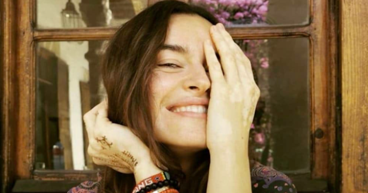 Kasia Smutniak mostra i segni della vitiligine sui social: “amare i propri difetti”