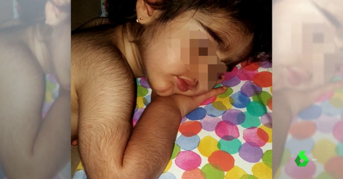 Diciassette bambini con la ‘sindrome del lupo mannaro’, dopo la contaminazione del Minoxidil