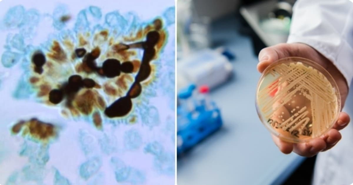 I medici lanciano l’allarme 2019: nuova infezione micotica letale resistente ai farmaci