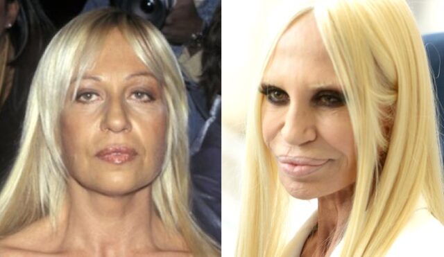 donatella-versace-prima-chirurgia