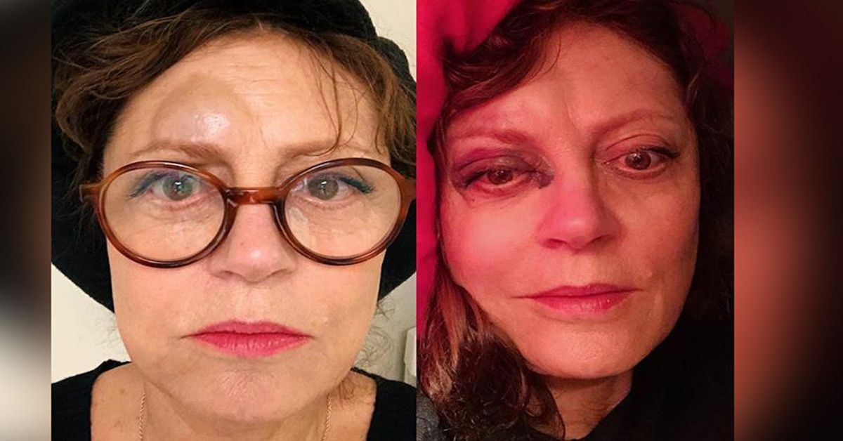 Susan Sarandon vittima di un brutto incidente: commozione cerebrale, naso fratturato e ginocchio rotto