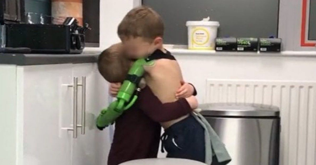 Jacob può abbracciare il suo fratellino grazie ad una protesi al braccio