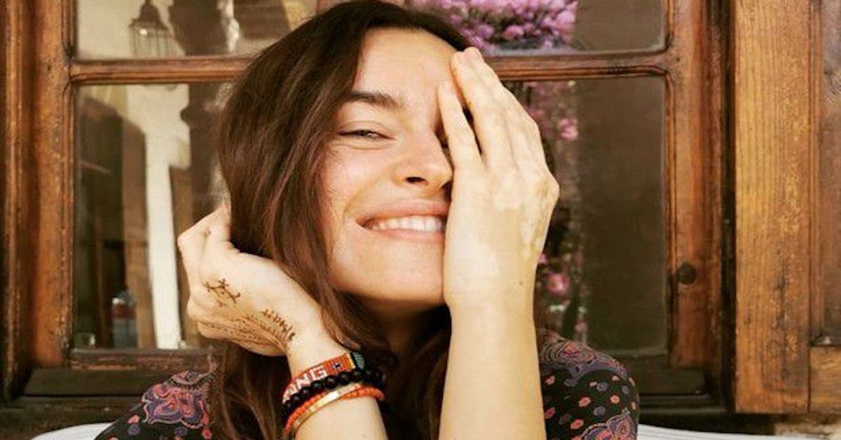 Kasia Smutniak torna a parlare della vitiligine: “per guarire sono stata perfino dai santoni”