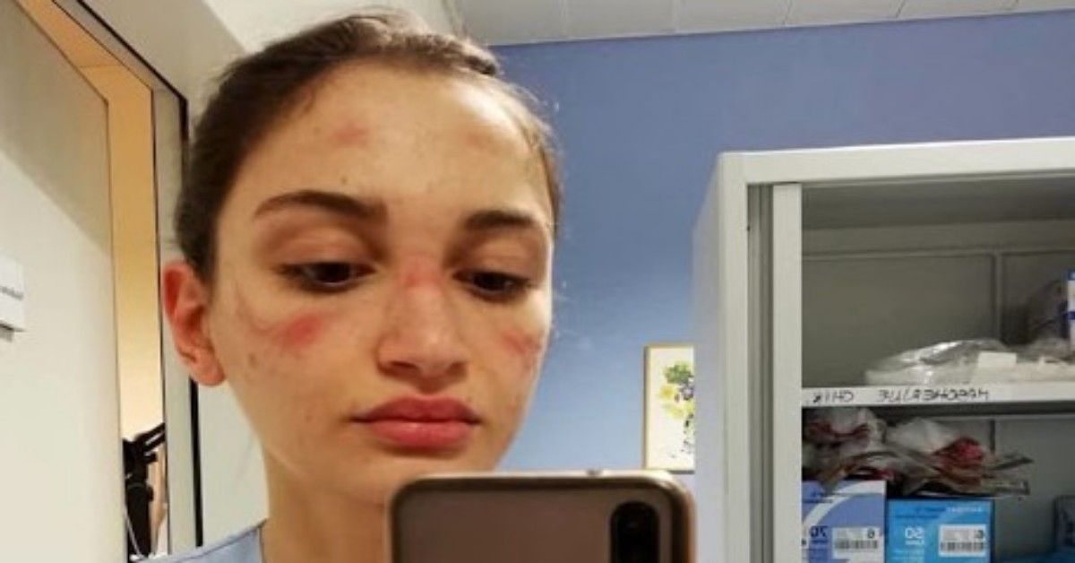 La foto dell’infermiera con i segni della mascherina sul volto