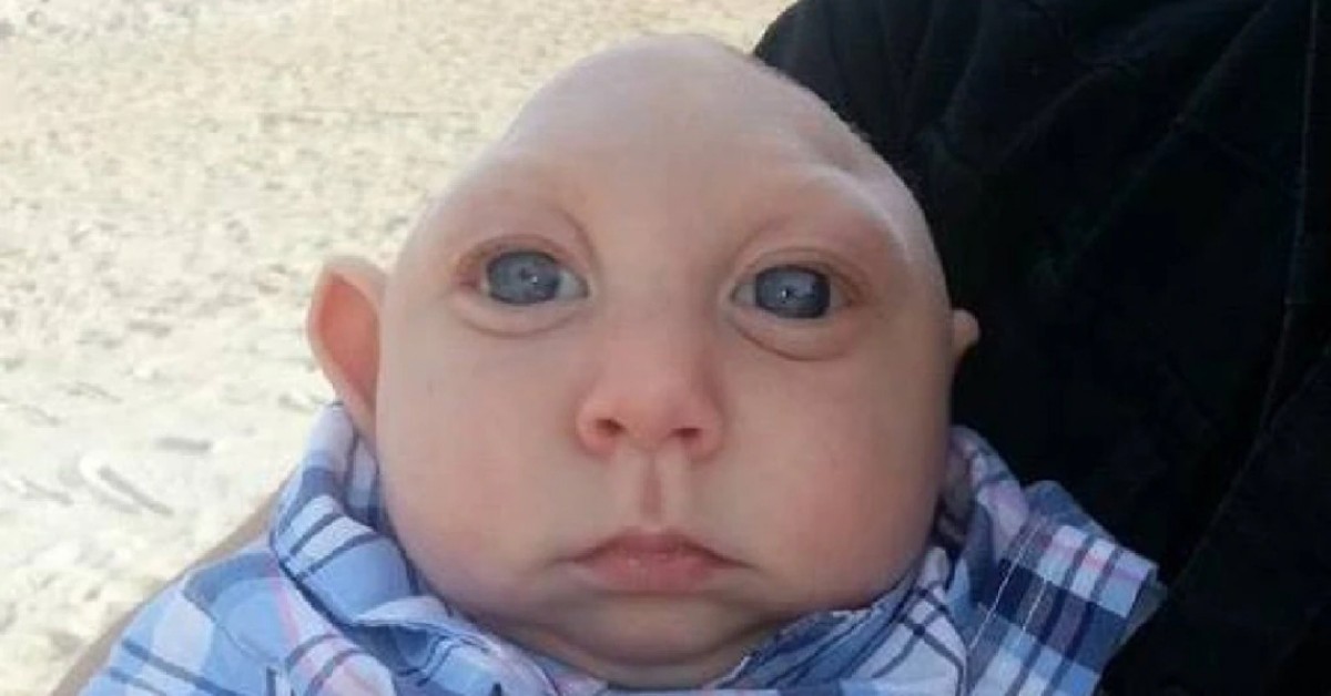 Si è spento Jaxon Buell, il bambino nato con una malformazione alla testa