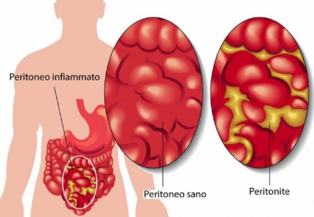 Complicazione appendicite