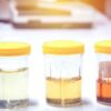 Colore delle urine