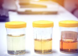 Colore delle urine