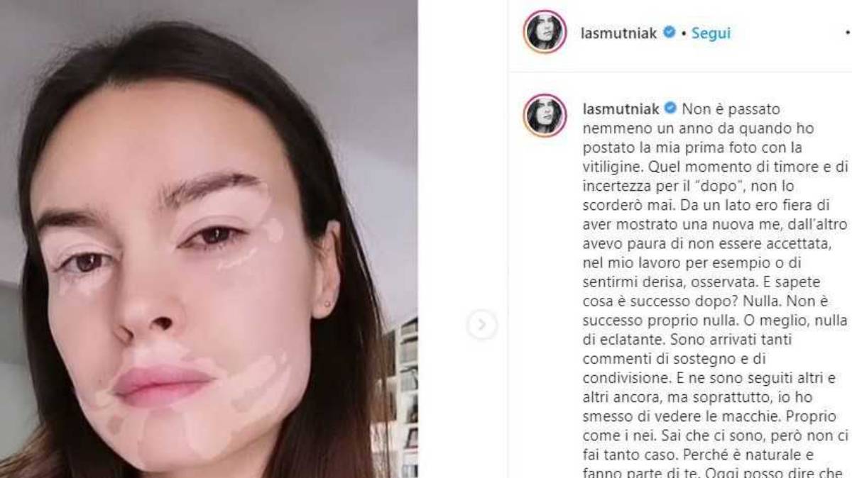 il filtro vitiligine di Kasia Smutniak