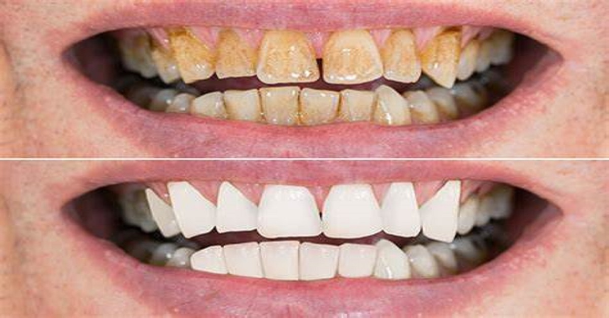 Ecco alcuni rimedi per avere sempre un sorriso smagliante
