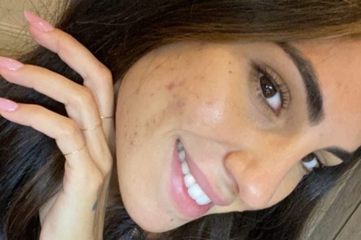 Giulia De Lellis acne