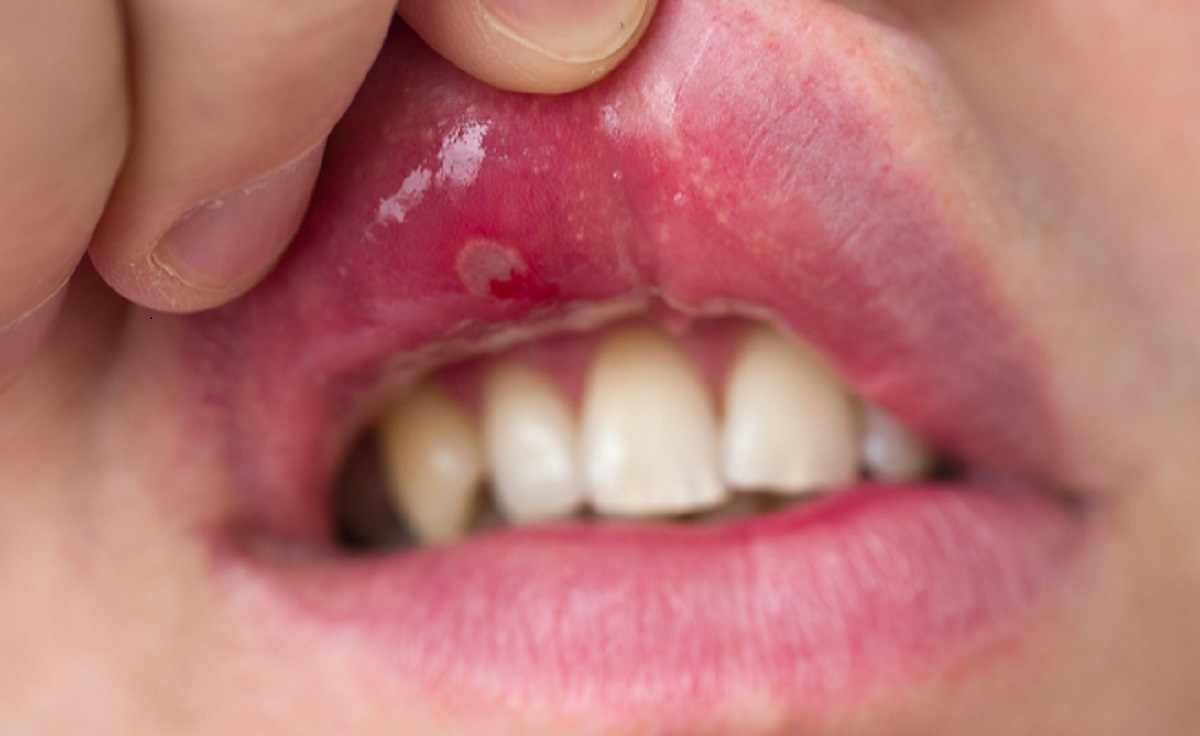 fastidio mucosa orale