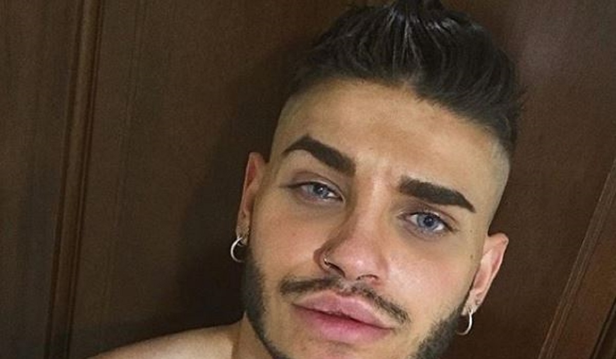 Cristian Imparato ricorre nuovamente alla chirurgia: ecco la foto con il volto tumefatto