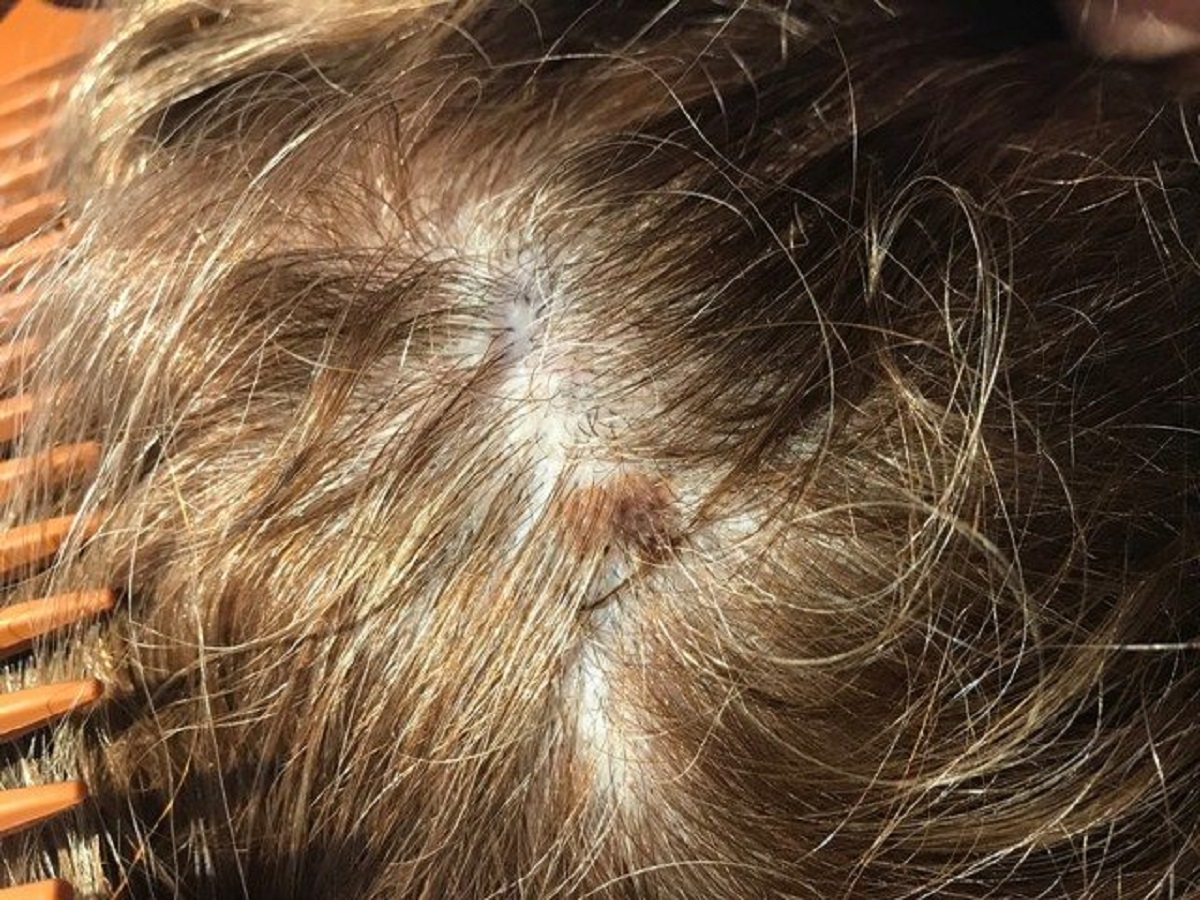 diagnosi melanoma