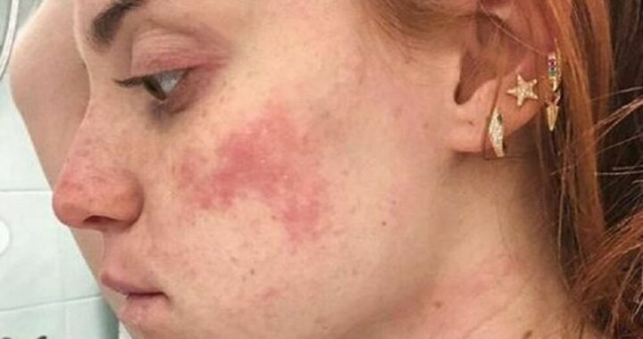 Ludovica Bizzaglia e la dermatite