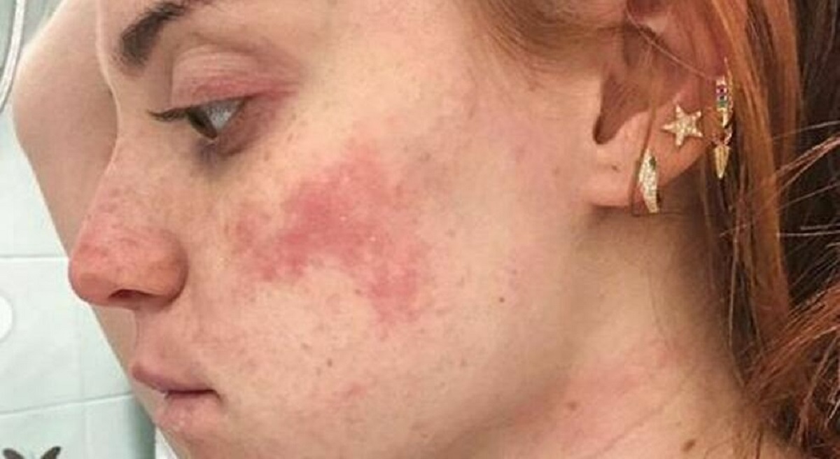 Ludovica Bizzaglia e la dermatite: foto per promuovere un messaggio skin positive