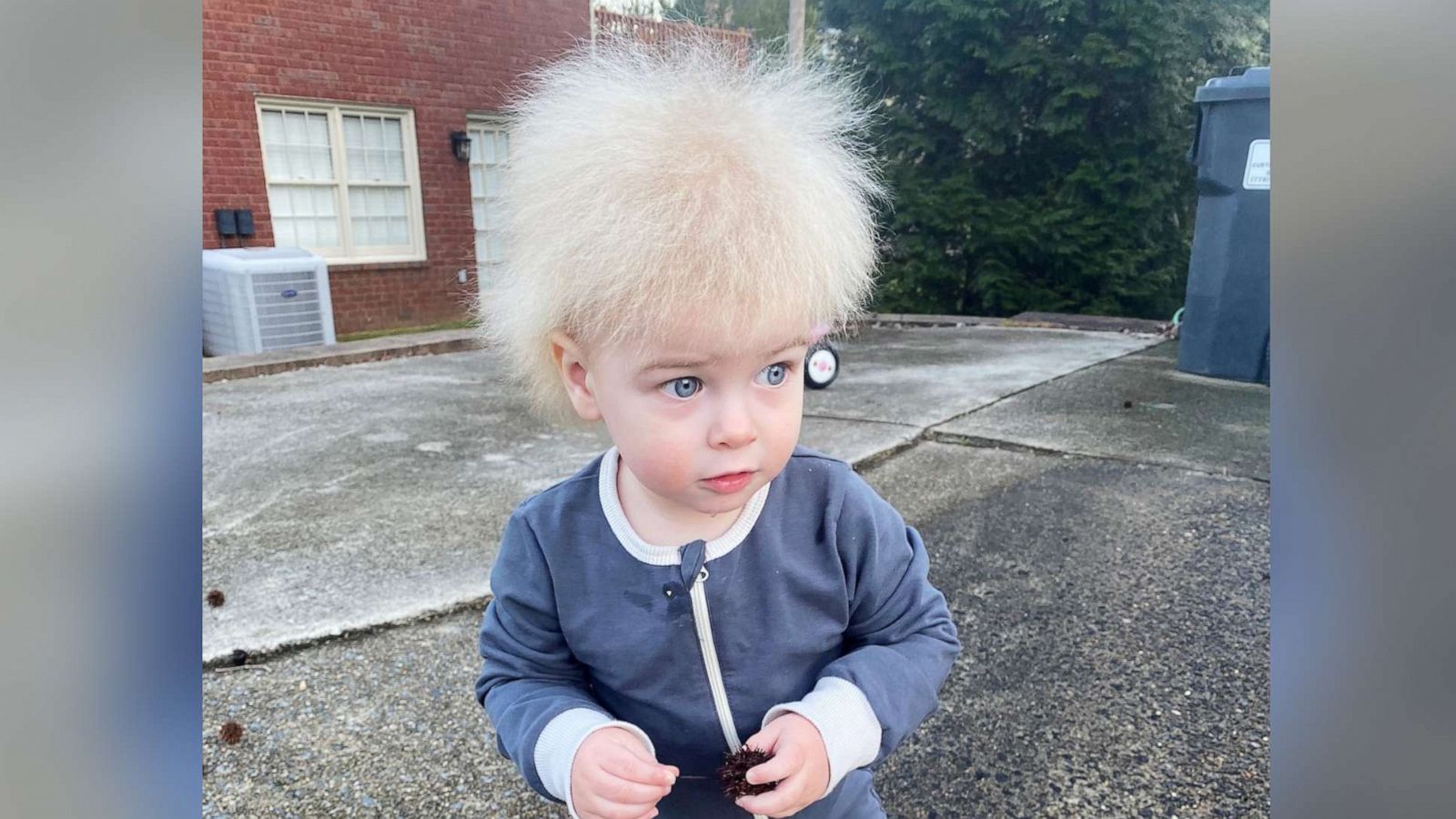 child with impettinabile hair syndrome