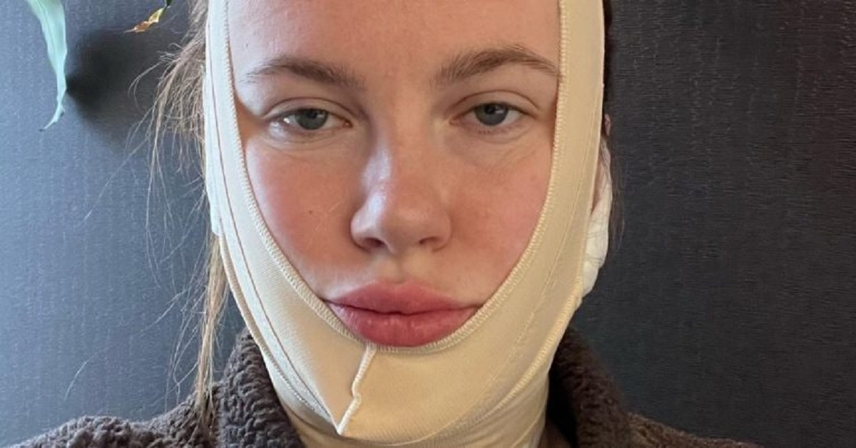 Ireland Baldwin e il lifting al viso