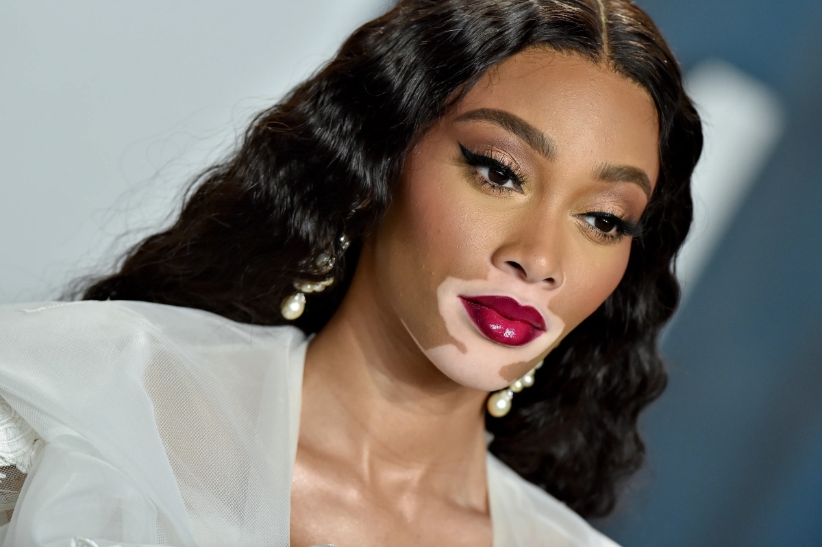 La vitiligine di Winnie Harlow