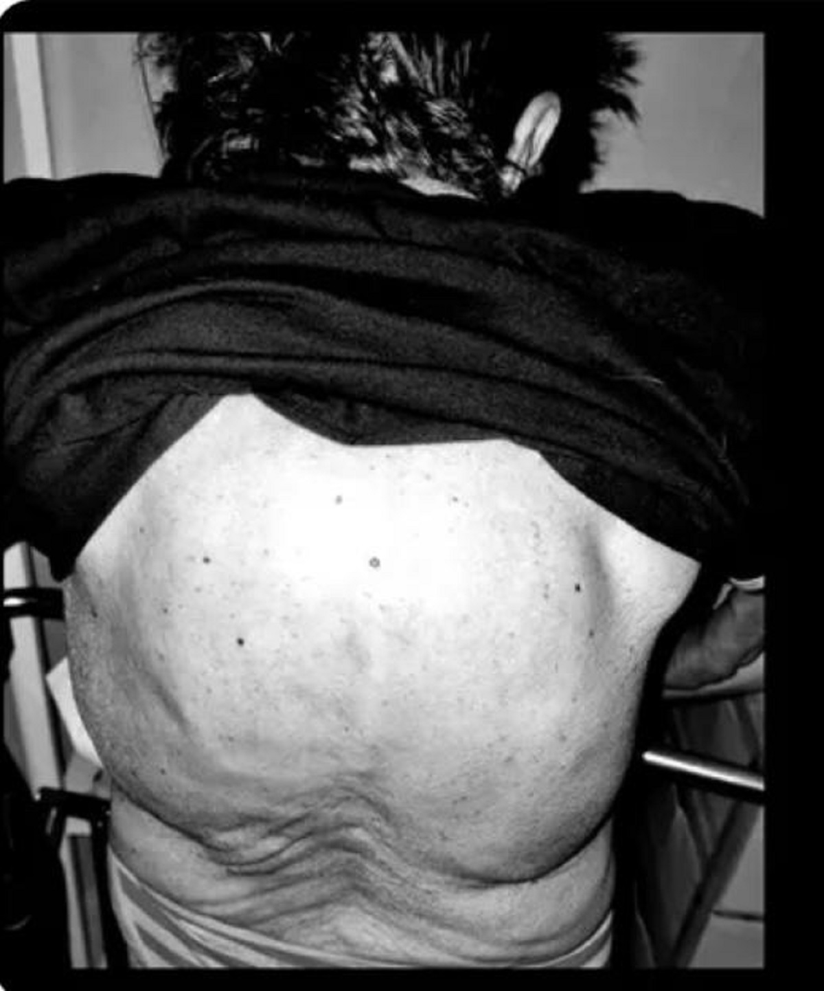 mielanoma multiplo