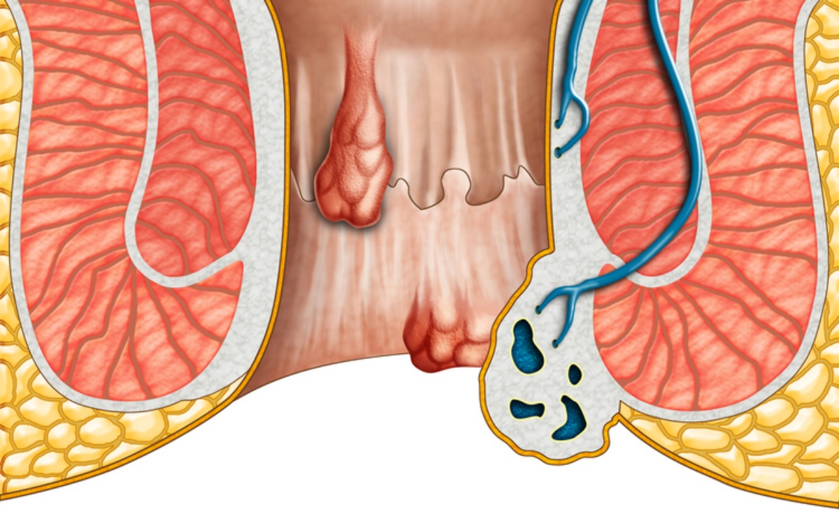 rimedi per eliminare le emorroidi