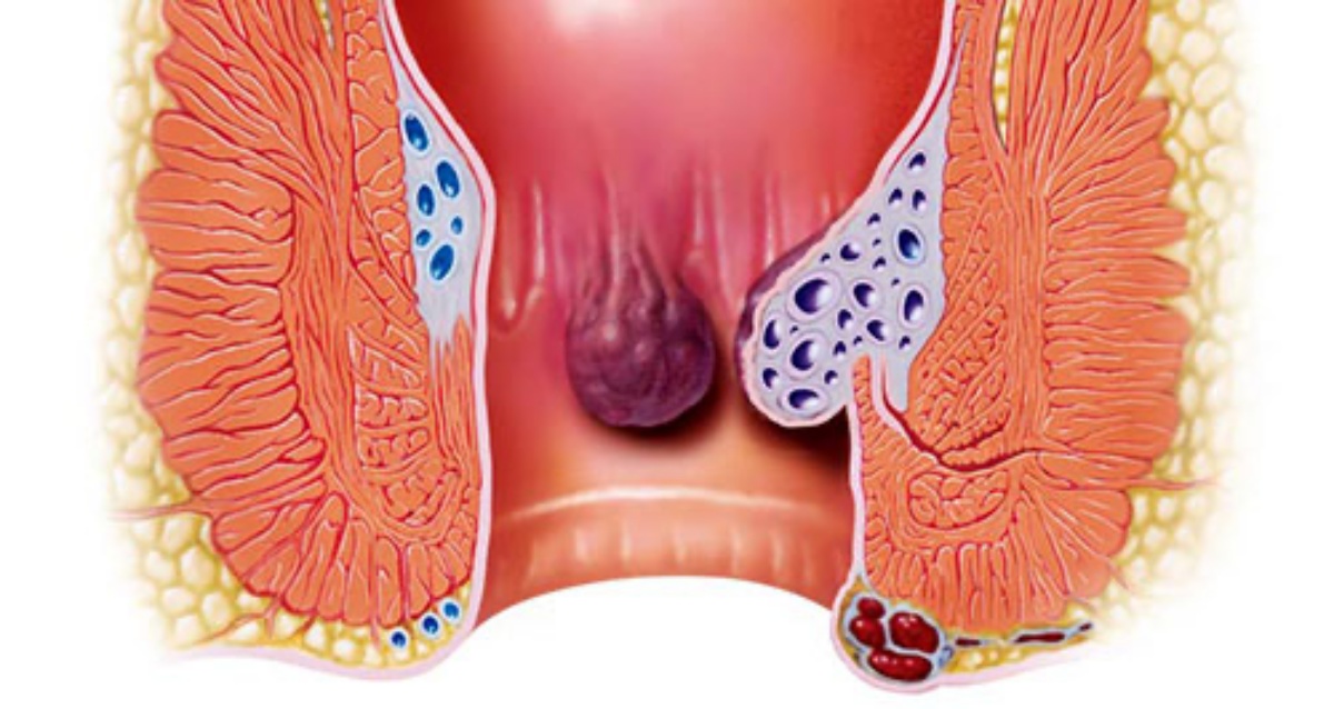 ricetta per eliminare le emorroidi