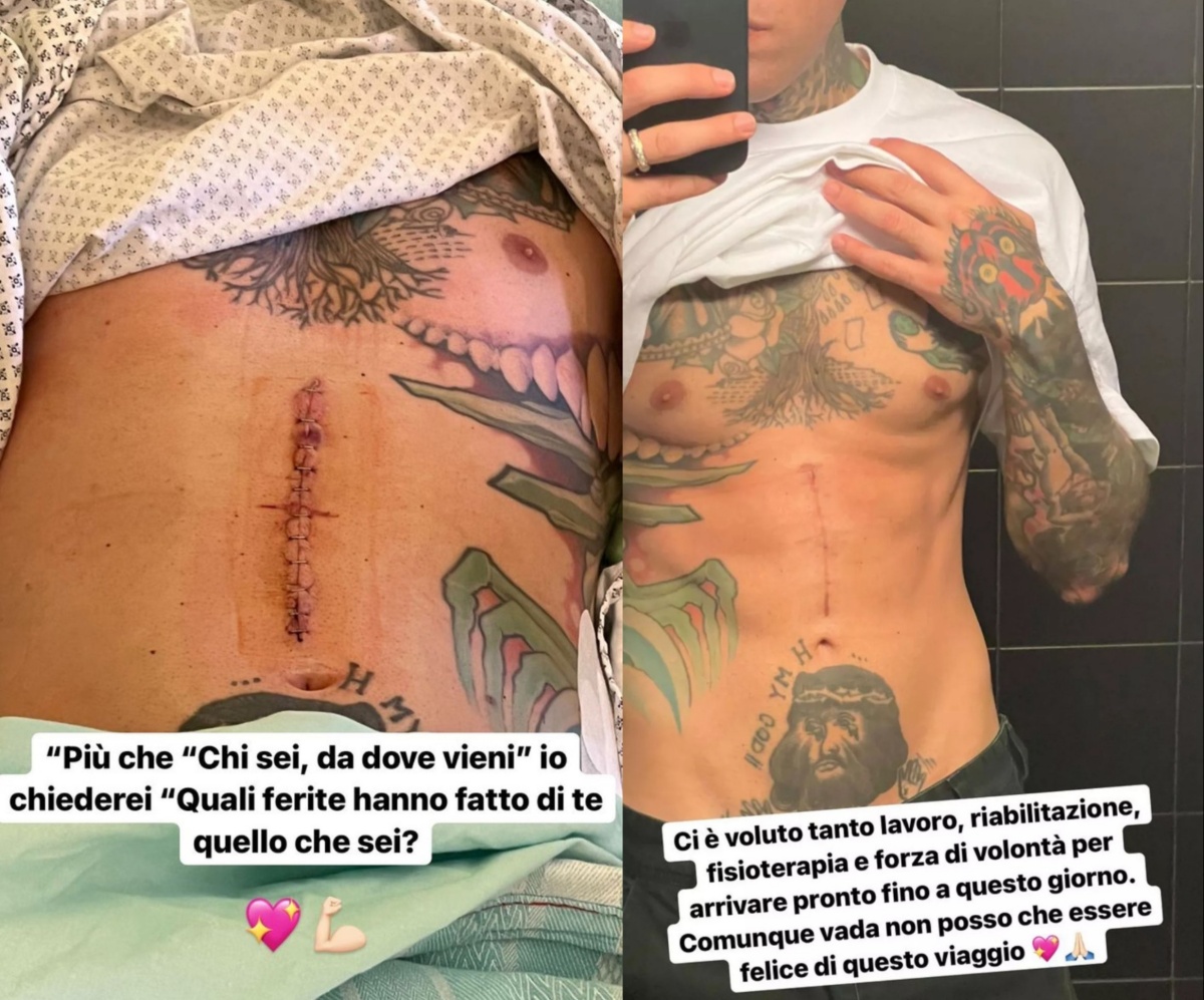 La cicatrice di Fedez 