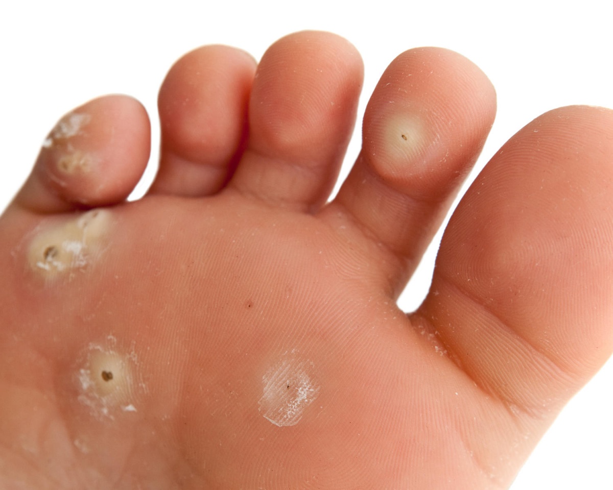 get rid of warts