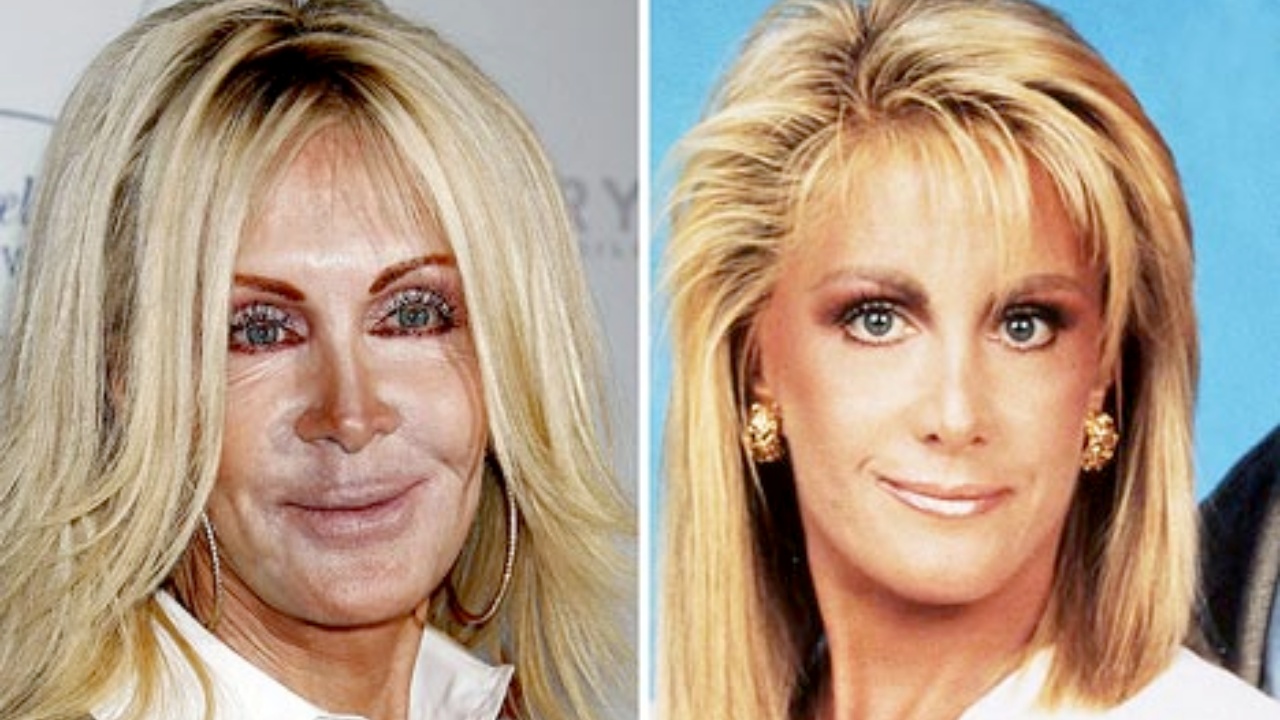 Joan Van Ark chirurgia estetica