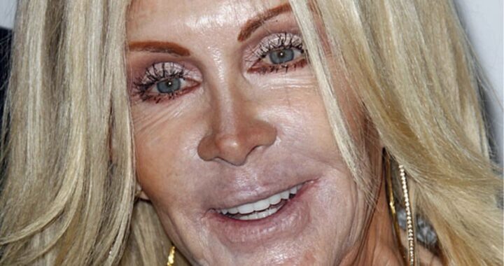 Joan Van Ark chirurgia estetica