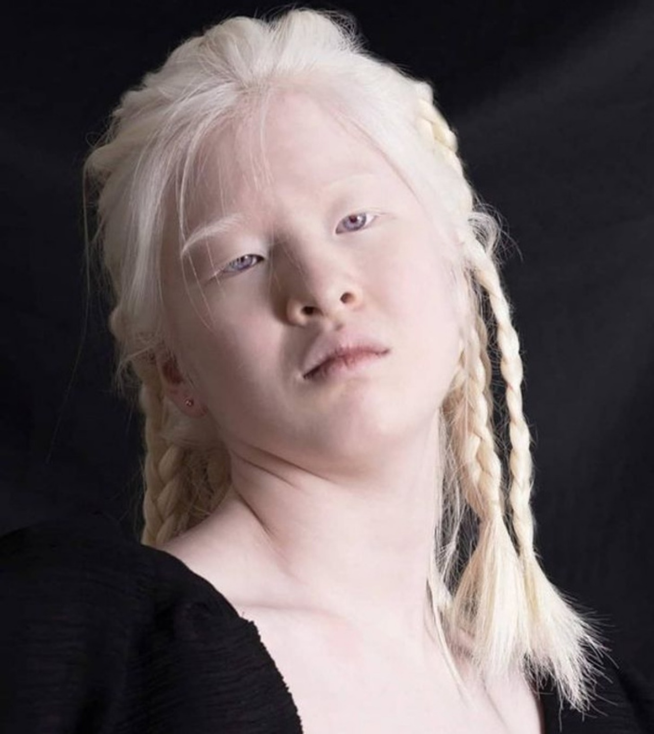 La storia della modella albina Xueli Abbing
