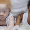 Mamma partorisce due gemelli, uno bianco e uno nero