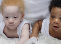 Mamma partorisce due gemelli, uno bianco e uno nero