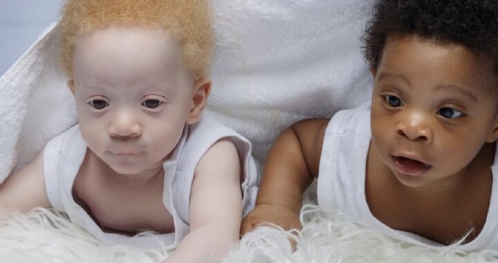 Mamma partorisce due gemelli, uno bianco e uno nero