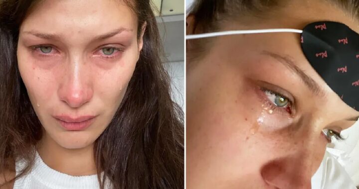 Bella Hadid infezione della mascella