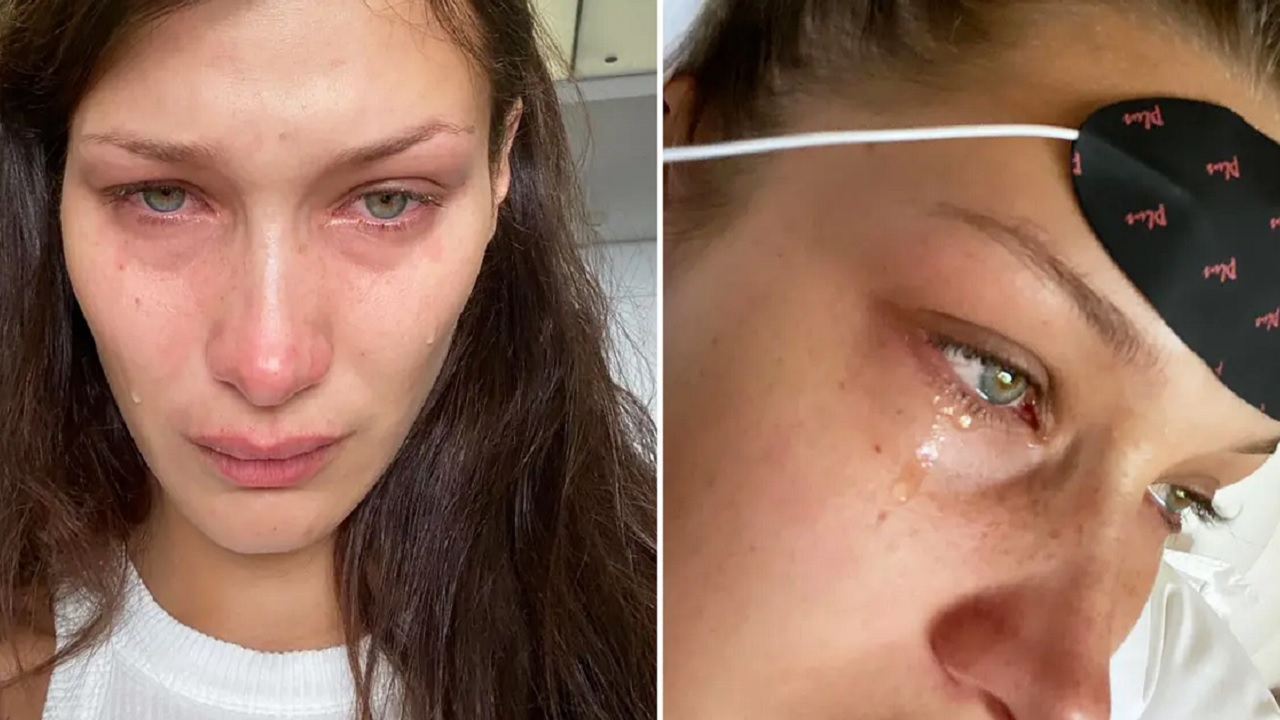 Bella Hadid infezione della mascella