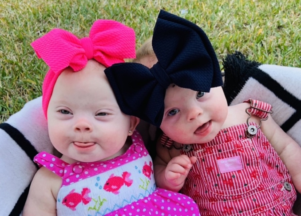 rara coppia di gemelli identici con sindrome di Down