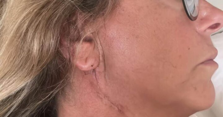 Roberta Beta Adenoma